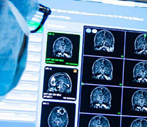 Auswertung neurologischer Befunde über Computer